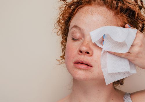 Toverhazelaar is een ouderwets ingrediënt tegen acne met echte voordelen