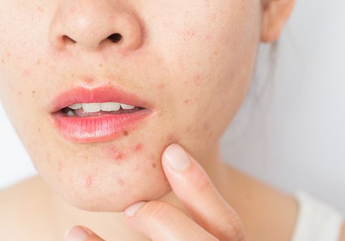 Como as Savvy Girls lidam com a acne hormonal - e tratam-na