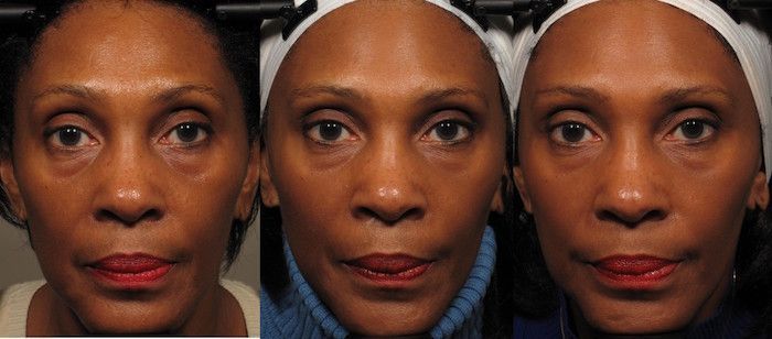 Disse sinnssyke før-etter-bildene viser at ansiktsøvelse virkelig fungerer