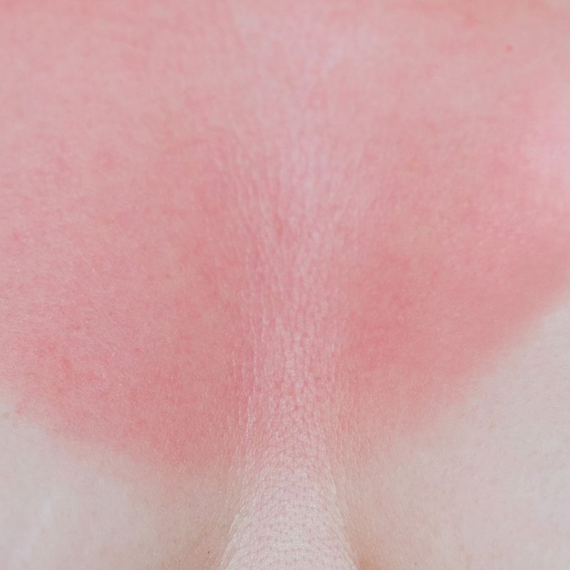 12 dicas recomendadas por dermatologistas para curar rapidamente uma queimadura solar