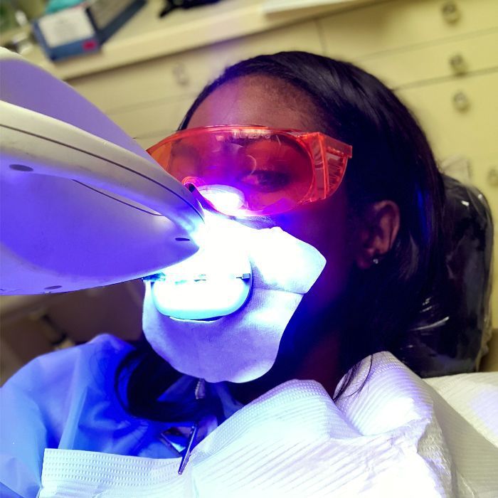 recenzie de albire a dinților cu laser
