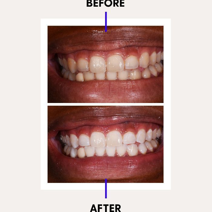Înainte și după albirea dinților cu laser