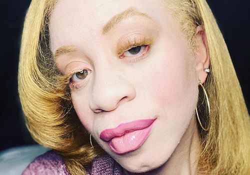 Güzellik Etkileyen Jennifer Renée Albinizm Hastaları İçin Bir Kirpik Çizgisi Oluşturdu