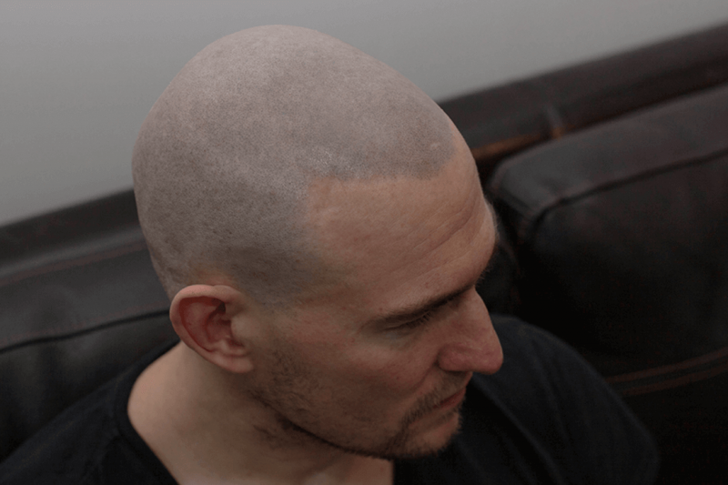 MicroPigmentazione del cuoio capelluto - Una 'cura' per la caduta dei capelli