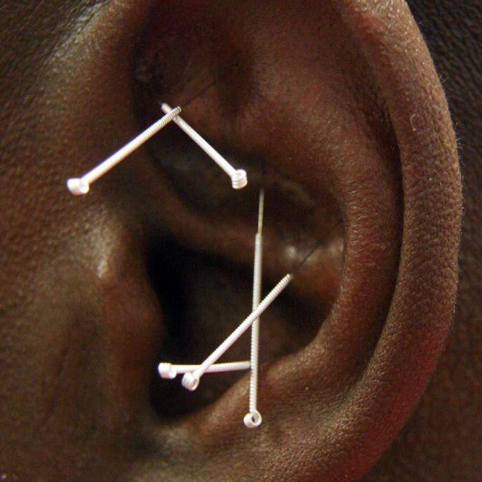 acupuntura auricular