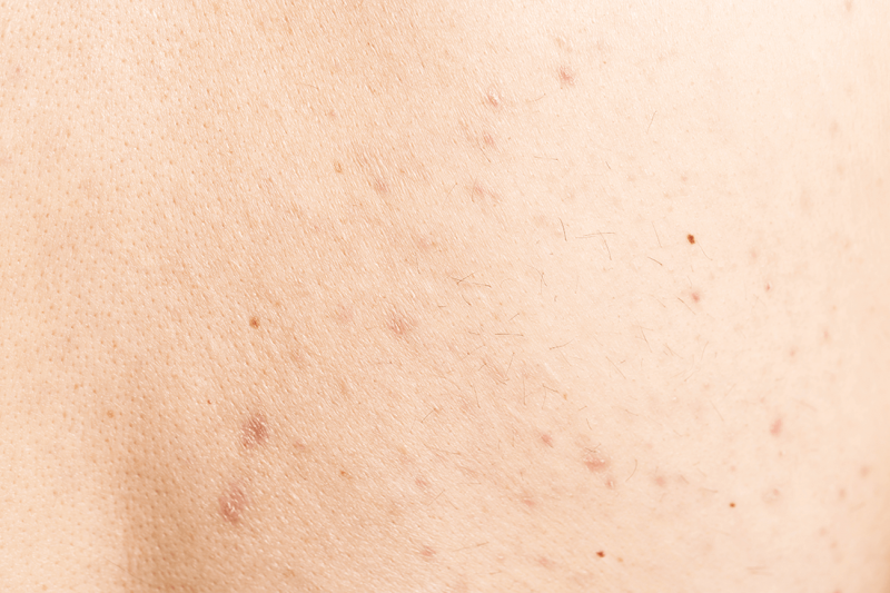 Os 10 principais mitos da acne