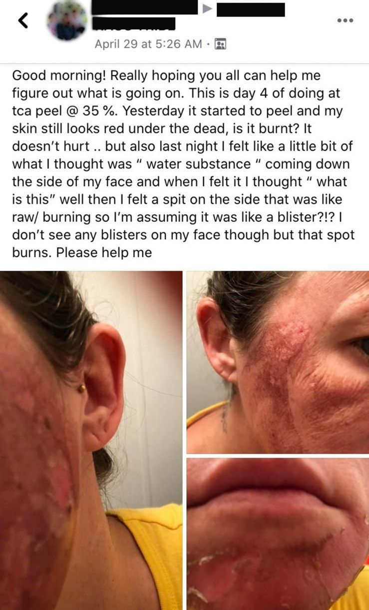 Эта медсестра публикует в Instagram ужасные фотографии людей, которые пробовали сделать химический пилинг своими руками в карантине