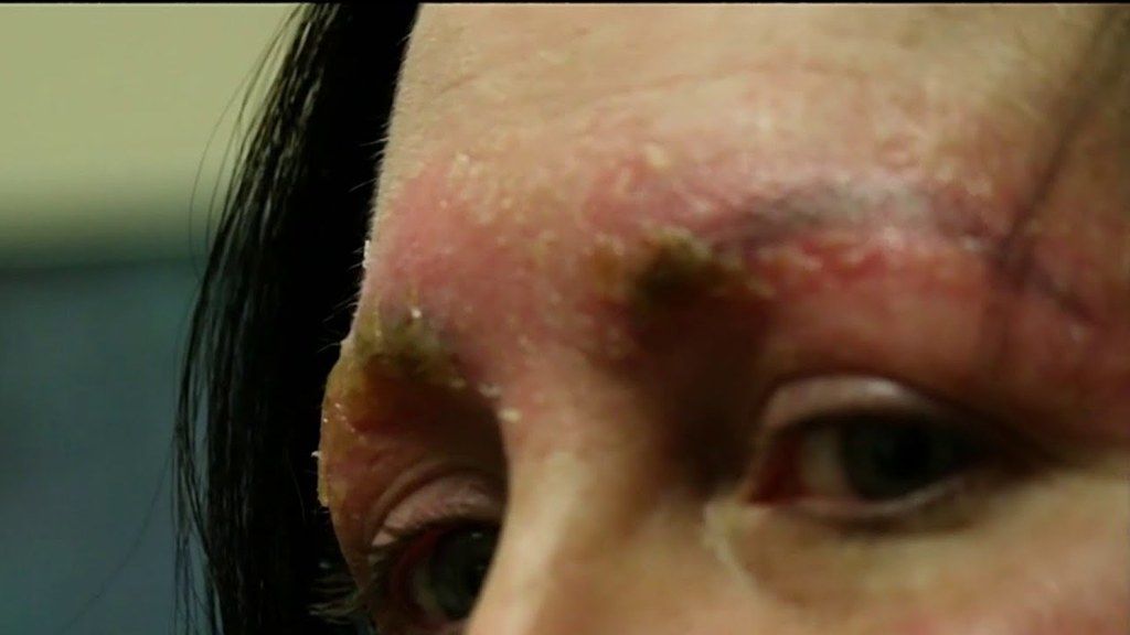 Esta mujer sufrió una infección horrible después de que le hicieran microblading en las cejas