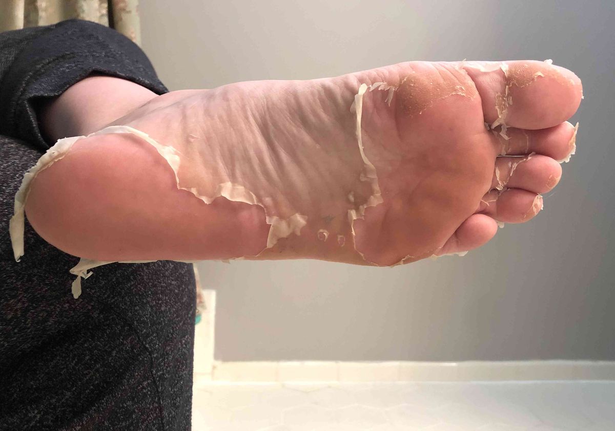 Baby fod skrælning hud